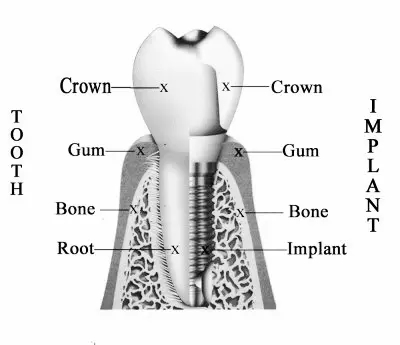 Dental Implants Procedure