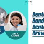 Bonding vs crowns