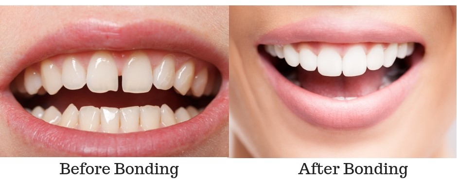Dental Bonding Before and After