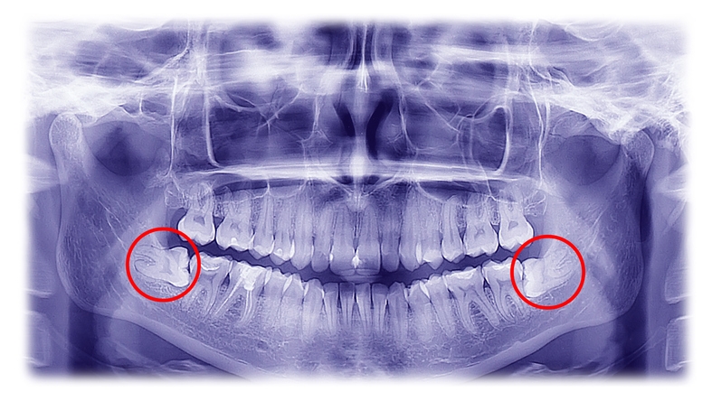 Wisdom Teeth X-ray