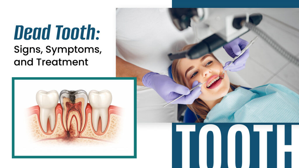 Dead Tooth: Signs, Symptoms, and Treatment