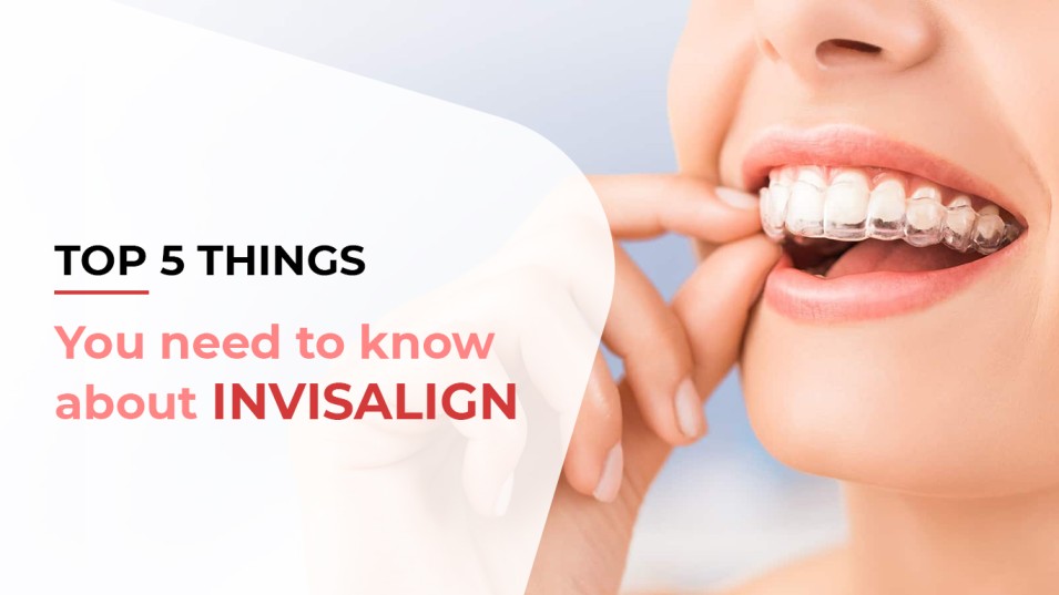 Top 5 things you need to Know about Invisalign