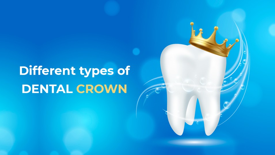 different types of dental crown