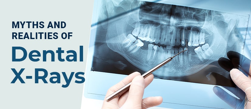 Myths and Realities of Dental X-Rays