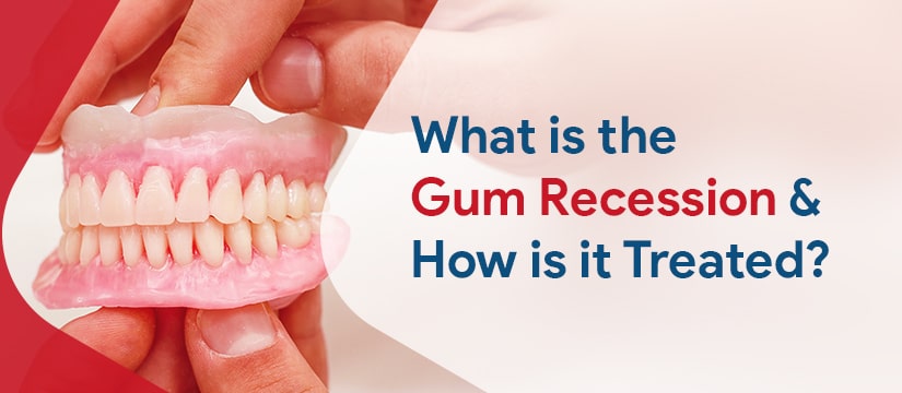 What is the Gum Recession and How is it Treated?