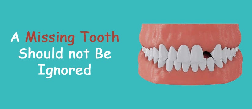 A Missing Tooth Should Not Be Ignored
