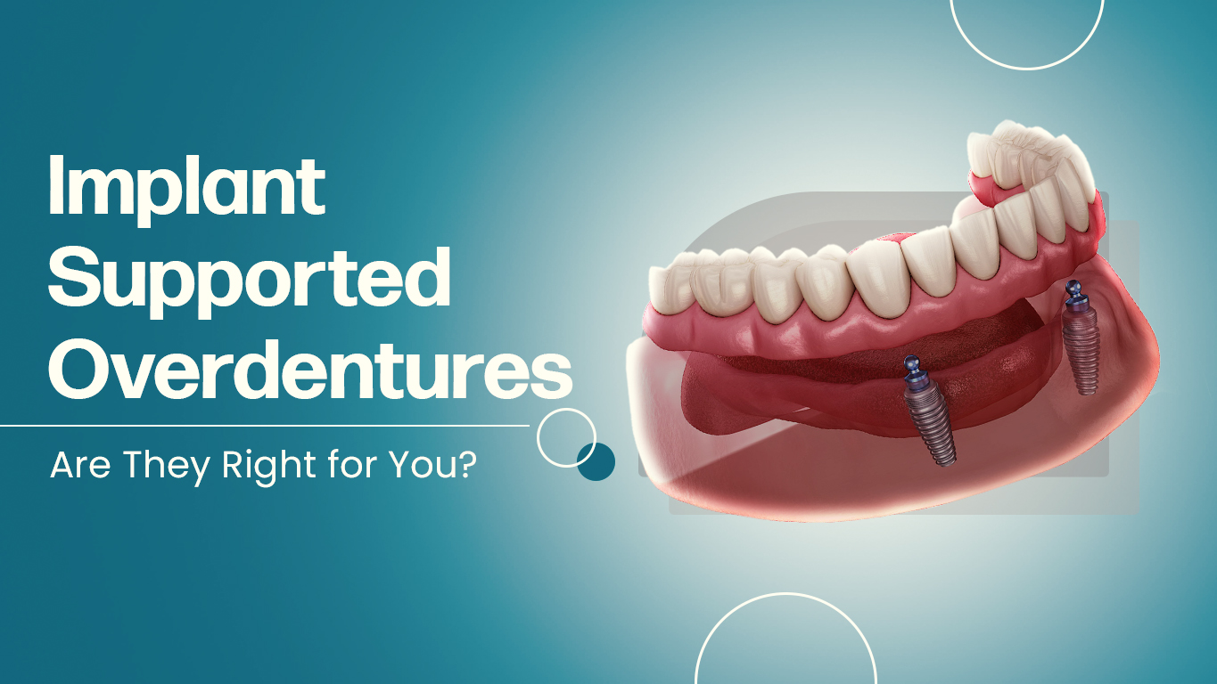 Implant-Supported Overdentures: Are They Right for You?