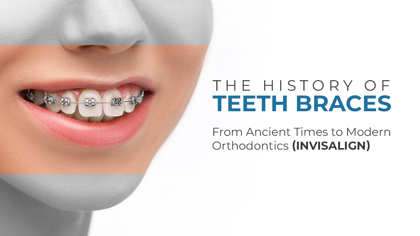 The History of Teeth Braces: From Ancient Times to Modern Orthodontics (Invisalign)