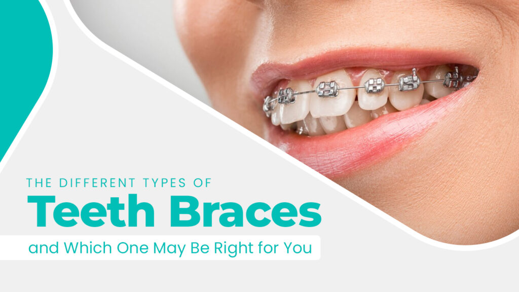 Teeth-Braces-