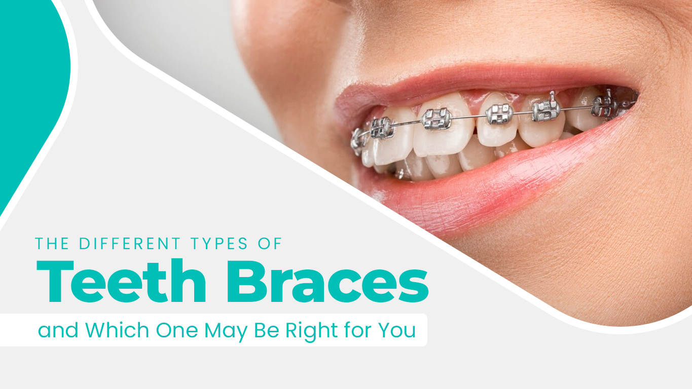 Teeth-Braces-