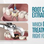 Root Canal or Extraction: Which Dental Treatment Is Right for You?