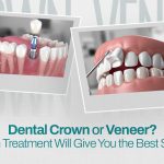 Dental Crown or Veneer