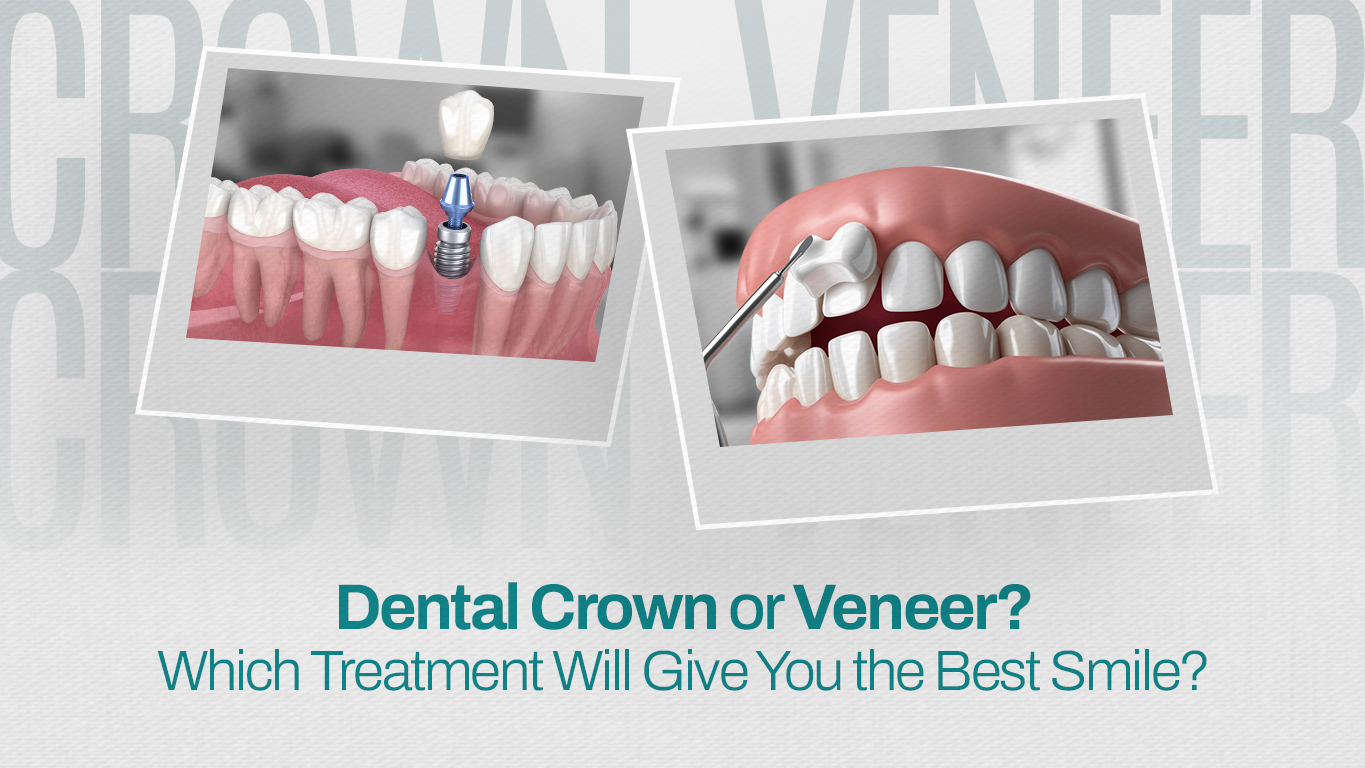 Dental Crown or Veneer