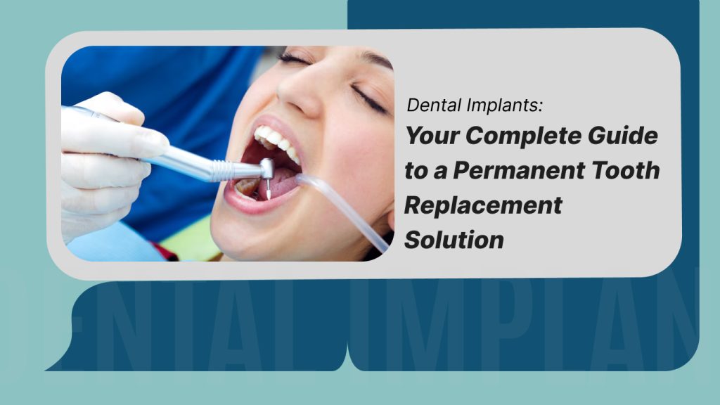Dental-Implants