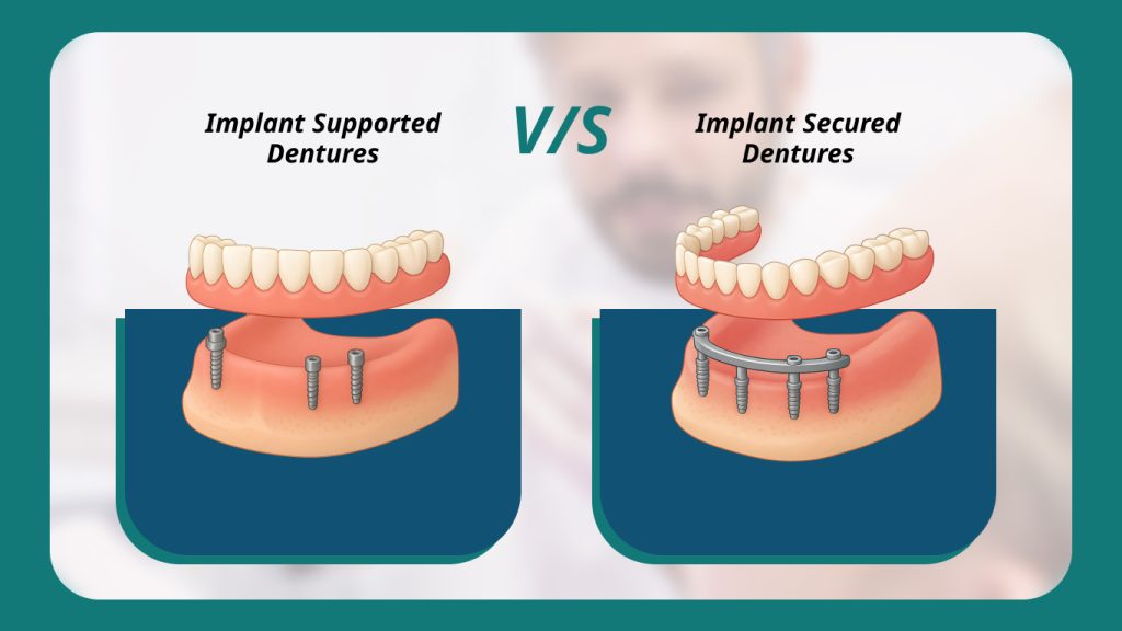 Implant Supported Dentures Vs Implant Secured Dentures Explained