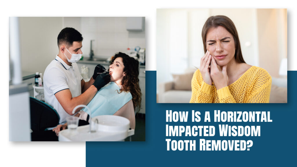 How Is a Horizontal Impacted Wisdom Tooth Removed?